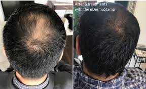 Hair Loss in Women and Men: Common Causes and Minimally-Invasive Treatment Options